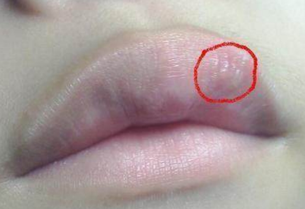 嘴唇肿痛是因为什么呢唇肿五大常见病因和临床表现揭秘