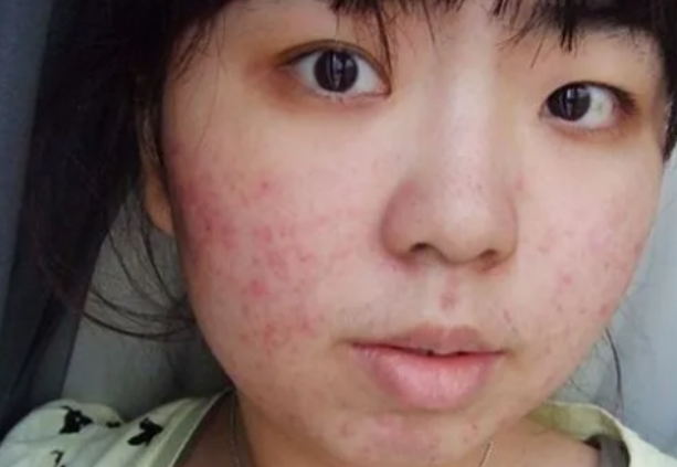 脸部皮肤过敏的原因是什么皮肤过敏应该怎么做