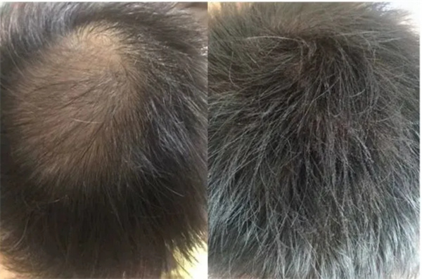 生发的男女治疗方法有哪些 脱发的类型有哪些？