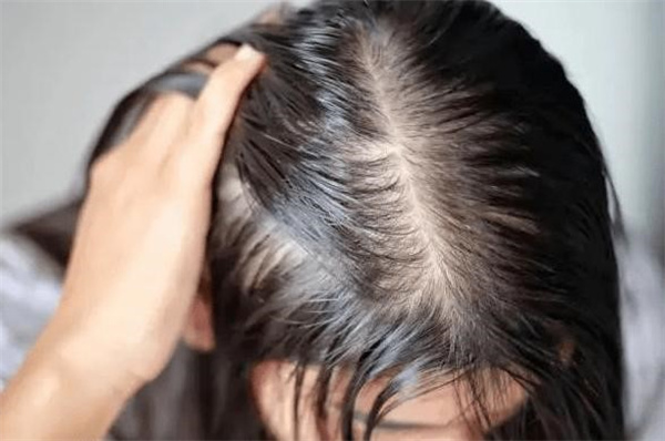 洗头掉多少头发 正常出现以下情况要引起重视
