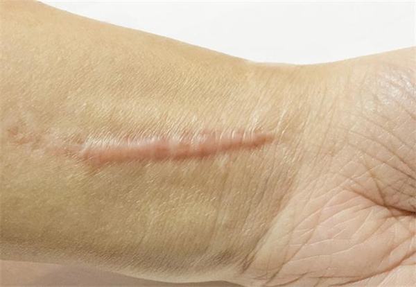疤痕体质如何去疤生姜疗法有效果