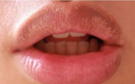 唇部有白色颗粒有这种症状要如何治疗