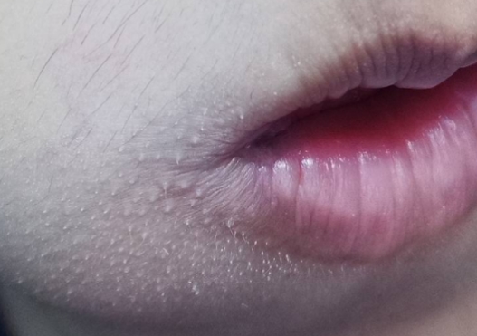 唇部有白色颗粒怎样才能去除