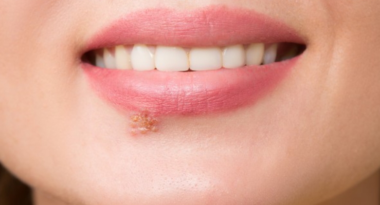 唇部有白色颗粒几点分析避免病情加重