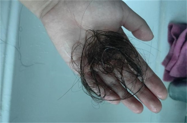 洗头掉多少头发 正常出现以下情况要引起重视