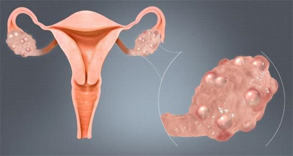 什么是卵巢水瘤 卵巢长瘤需要开刀吗