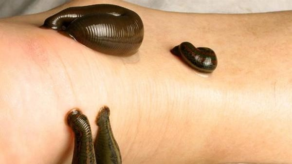 水蛭吸血真的能从皮肤进入到人体内寄生吗
