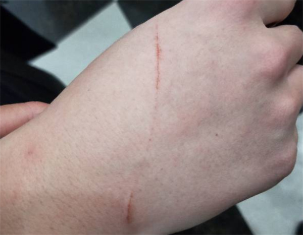 被猫抓伤怎么治疗 猫咪抓伤治疗方法