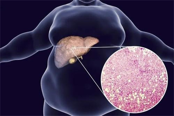 脂肪肝有并发症吗 脂肪肝会引起什么病变
