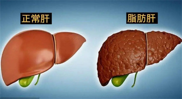 脂肪肝会传染吗 脂肪肝会变成肝癌吗