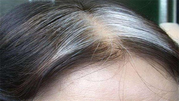 有白头发染什么颜色好 有白头发会遗传吗