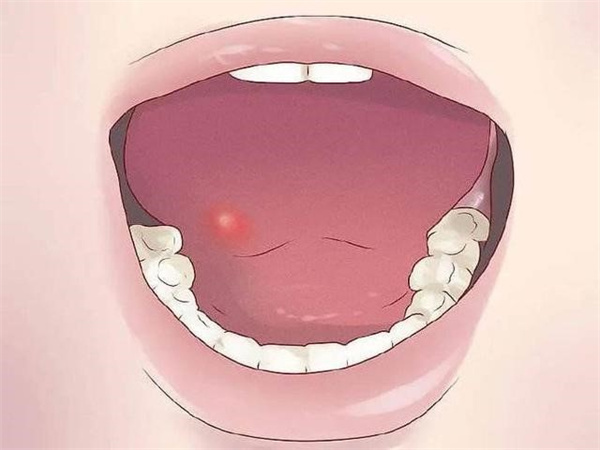 口腔溃疡具有传染性吗 口腔溃疡具有遗传性吗