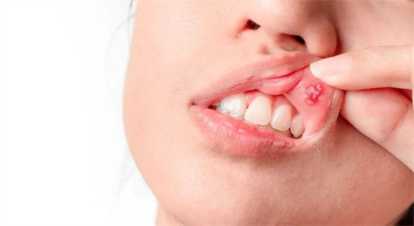 口腔溃疡是什么症状 口腔溃疡是什么原因造成