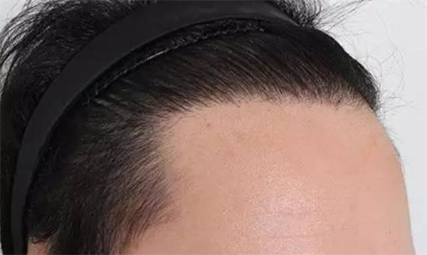 植发是用自己的头发移植吗 植发的危害和后遗症