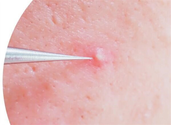 粉刺能用粉刺针吗 粉刺针去粉刺对皮肤有伤害吗
