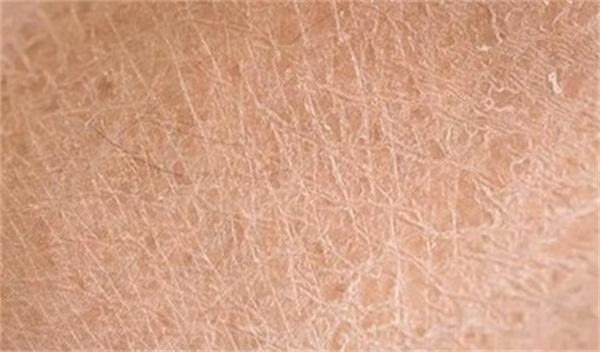 皮肤干燥的症状有哪些 皮肤干燥是什么器官有问题