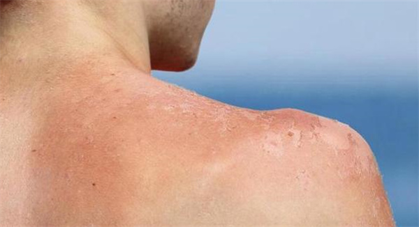 皮肤晒伤的急救方法 皮肤晒伤是怎么回事