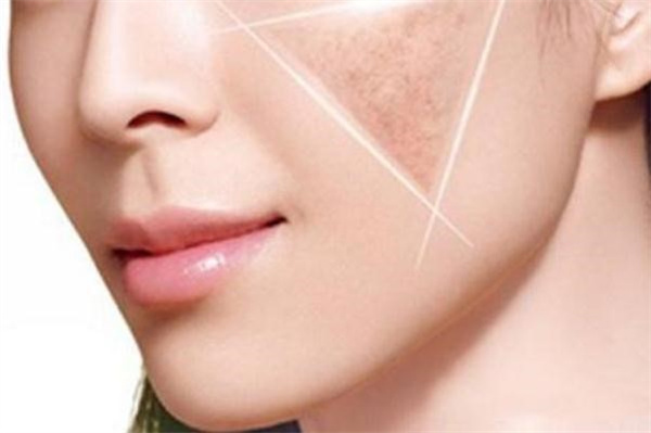 皮秒祛斑会使皮肤变薄吗 皮秒祛斑会伤害角质层吗