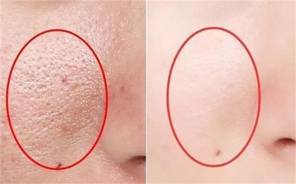 毛孔粗大怎么办怎么收缩毛孔 毛孔粗大用什么护肤品可以改善