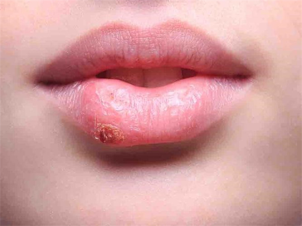 唇炎为什么反复发作 唇炎为什么长期不好