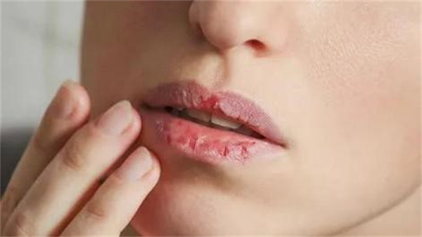 唇炎为什么反复发作 唇炎为什么长期不好