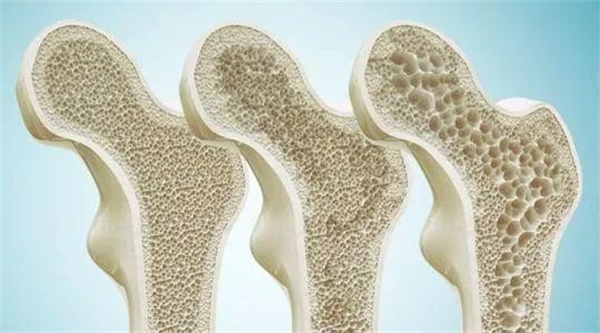 骨质疏松的主要原因 骨质疏松症的好发人群