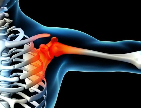 肩周炎是哪个部位痛 肩周炎是几级疼痛