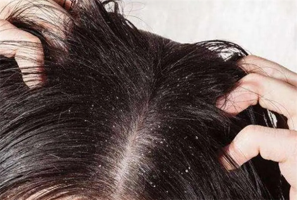 发胶会导致脱发吗 发胶的危害